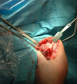 Schulter TEP mit TiREX®